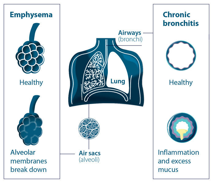 copd and coughing up mucus